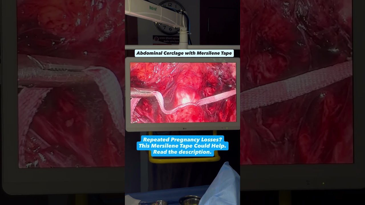 Abdominal Cerclage with Mersilene Tape
