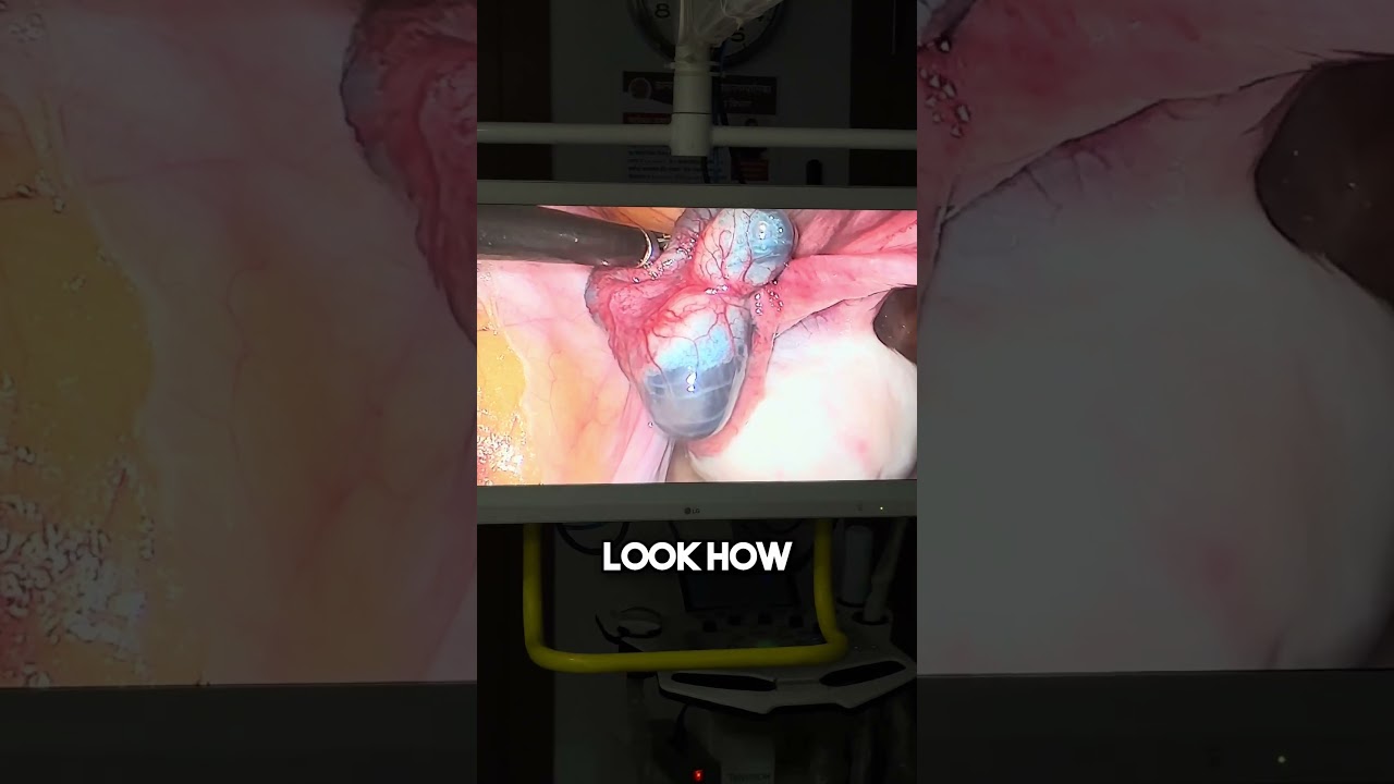 Open Tubes Don’t Always Mean Fertility!