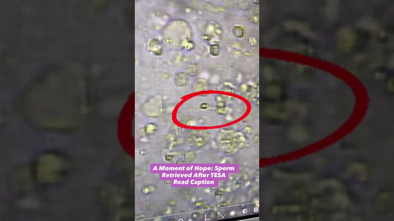 Sperm Found After TESA! The Search Under the Microscope