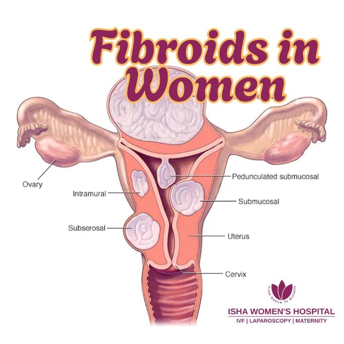 Fibroids in Women - Causes, Symptoms and Treatment