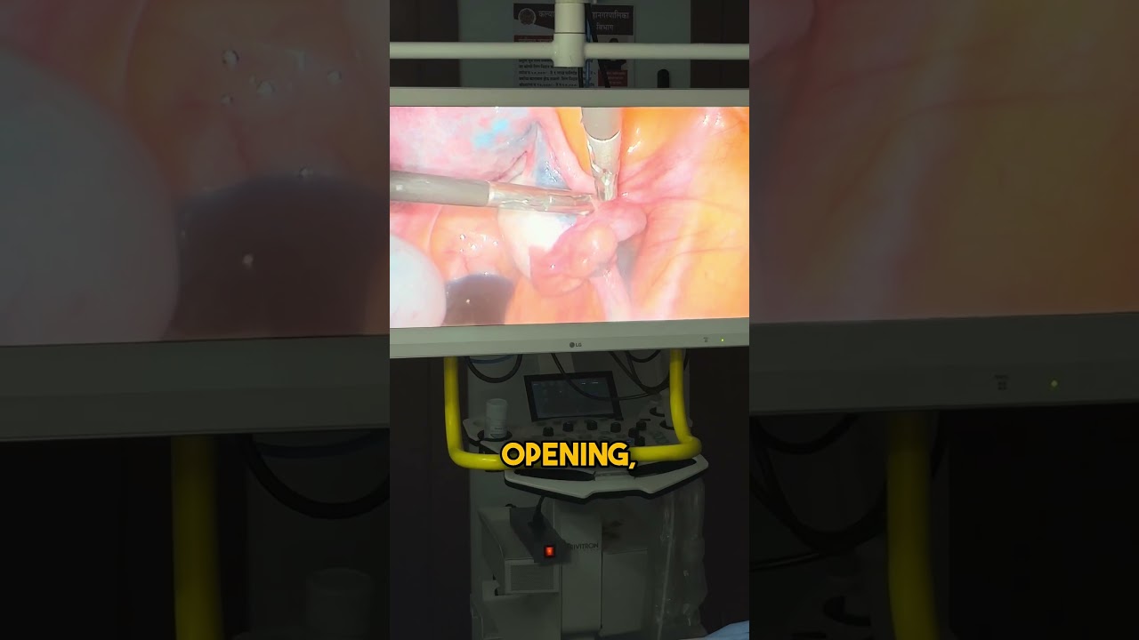 Fallopean Tubes Reality!