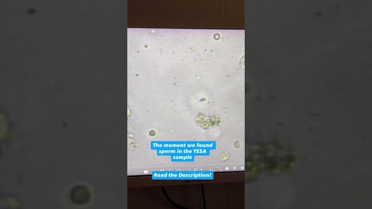 Searching for sperm after TESA