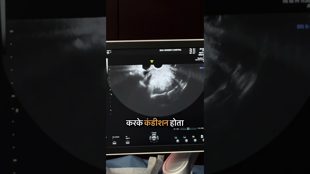Microwave Ablation For Adenomyoma!