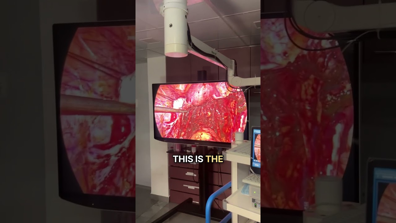 Severe Endometriosis: A Classical Case