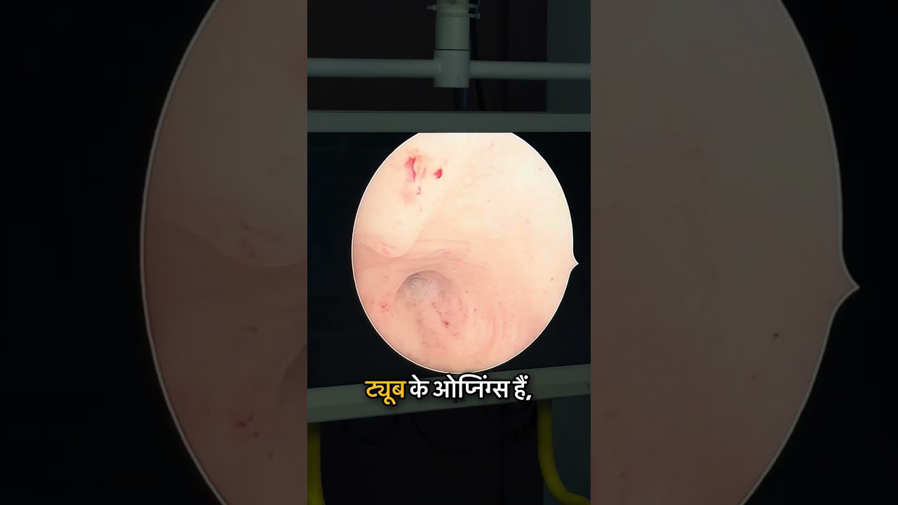 Hysteroscopy Explained!