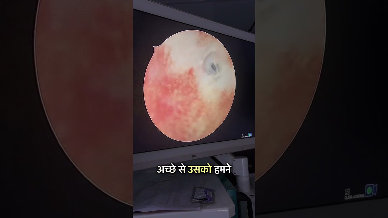 Why Hysteroscopy Can Reveal What HSG Misses