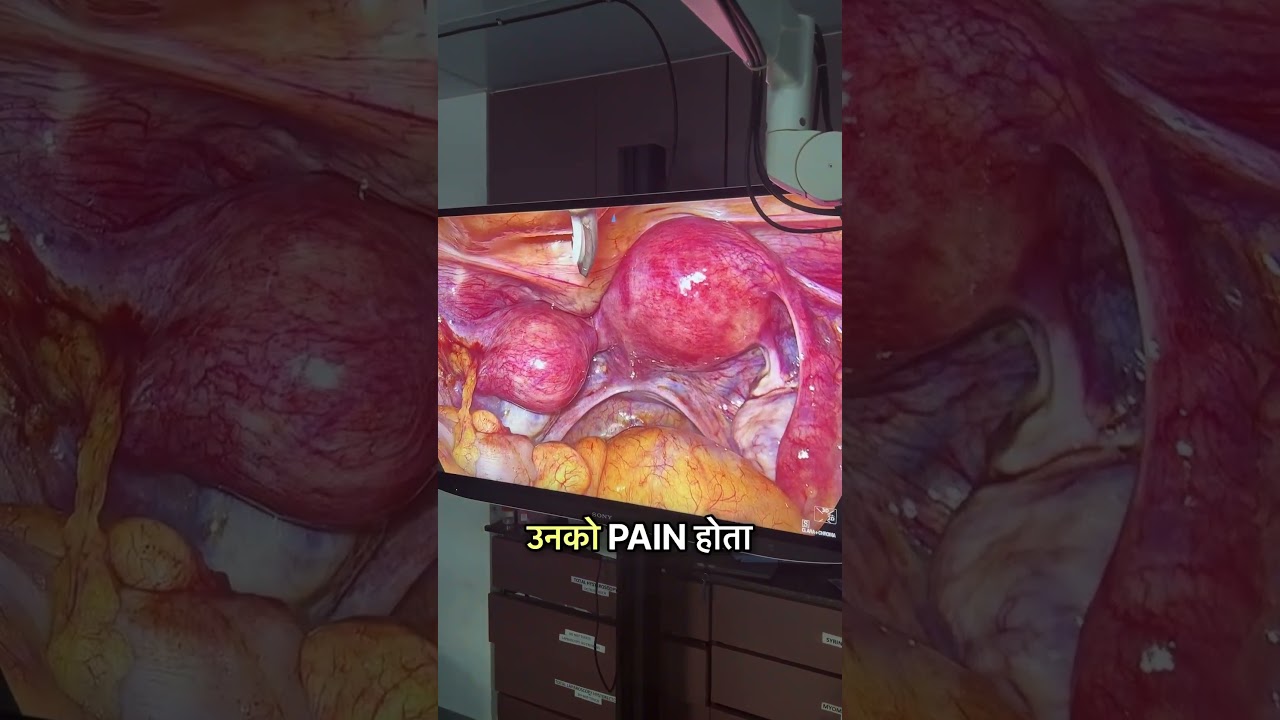 Severe Period Pain Caused by a Rudimentary Horn