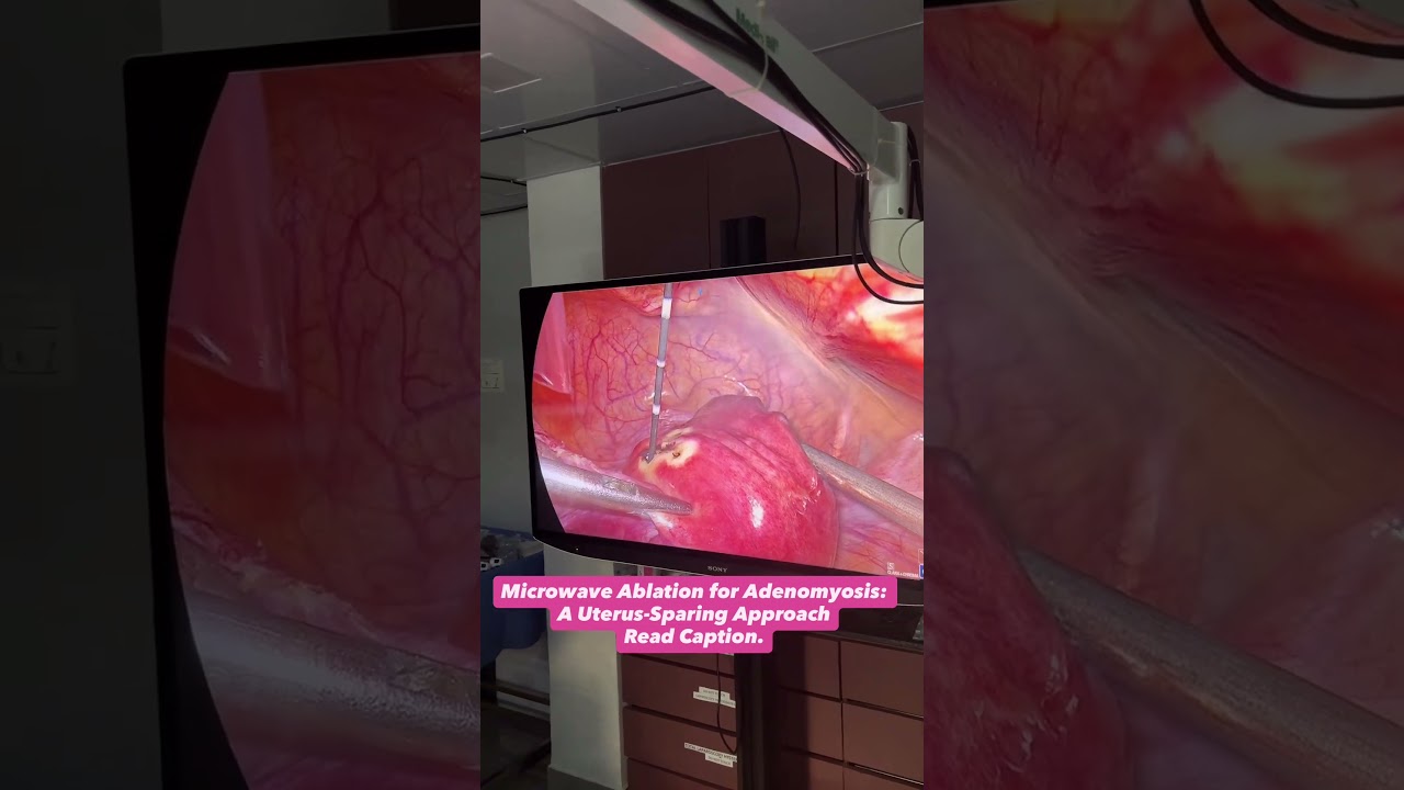 Microwave ablation Read Caption