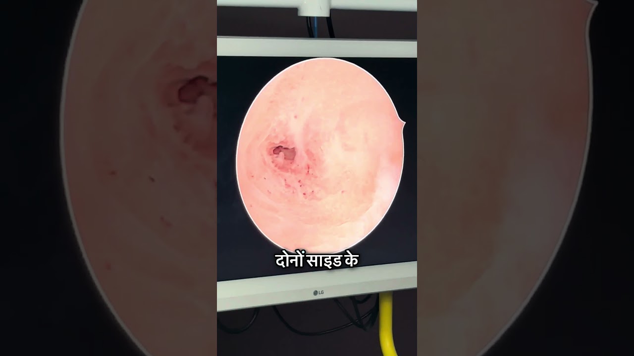 Opening Blocked Tubes!!