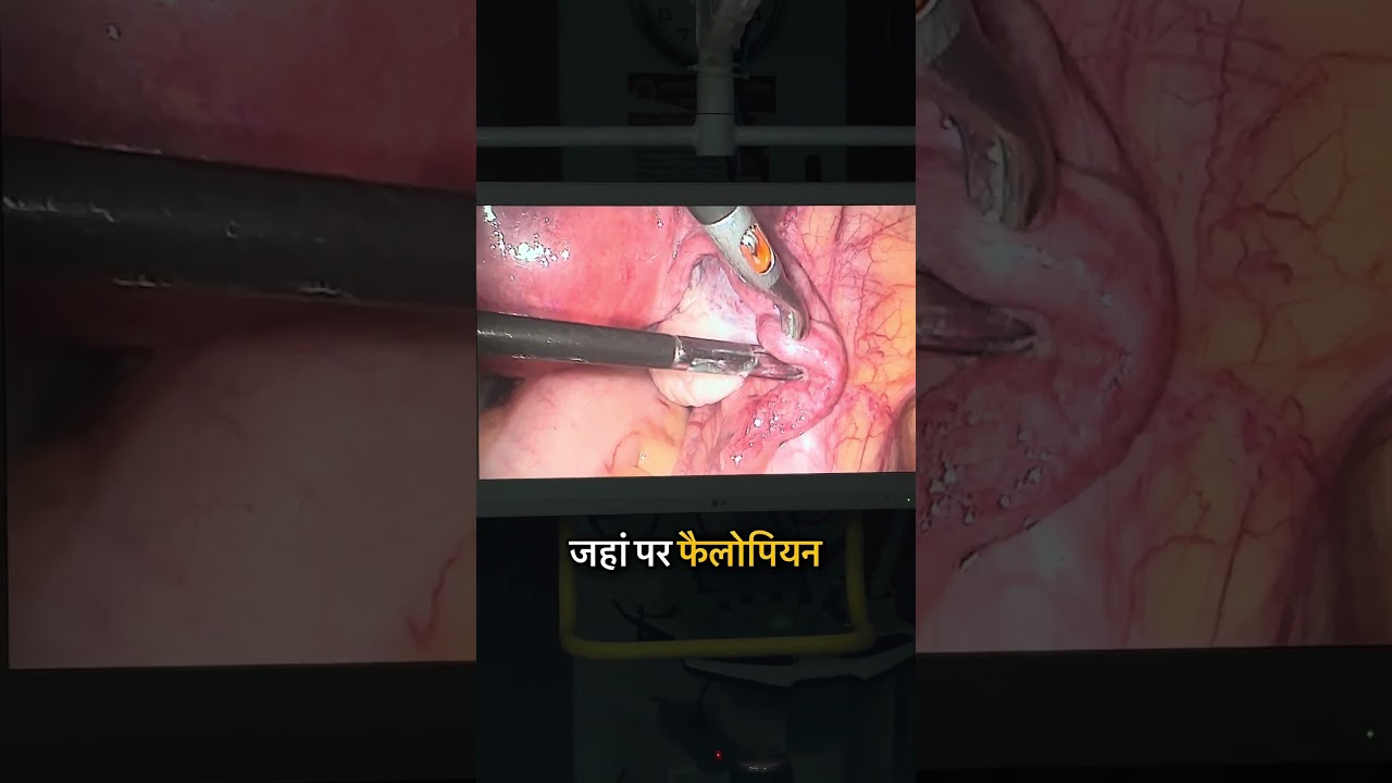 Secondary Infertility!