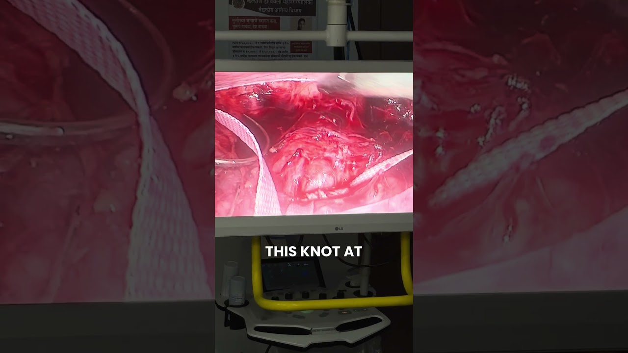 Laparoscopic Abdominal Cerclage!