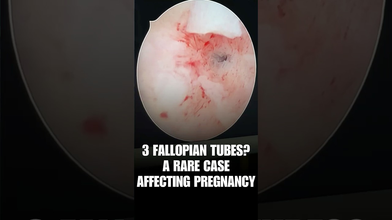 3 fallopian tubes?