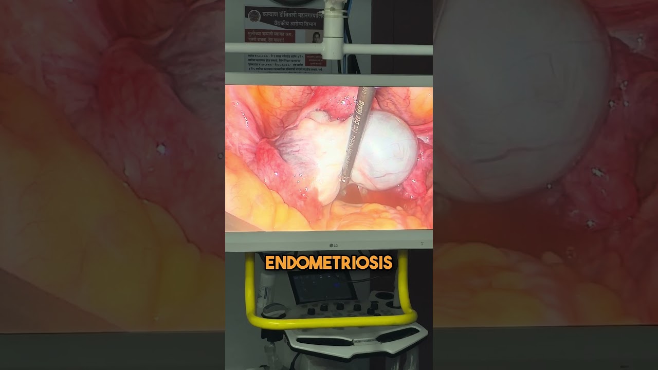 Chocolate Cyst Surgery!