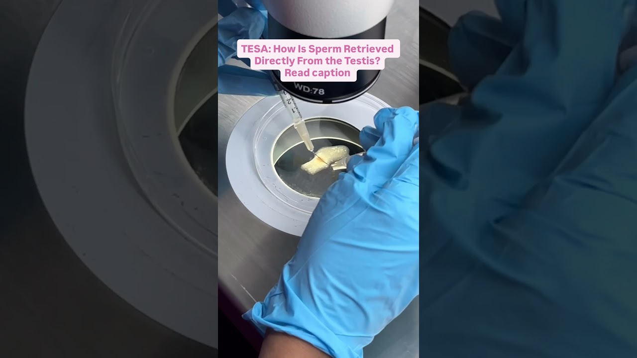 Testicular Sperm Aspiration