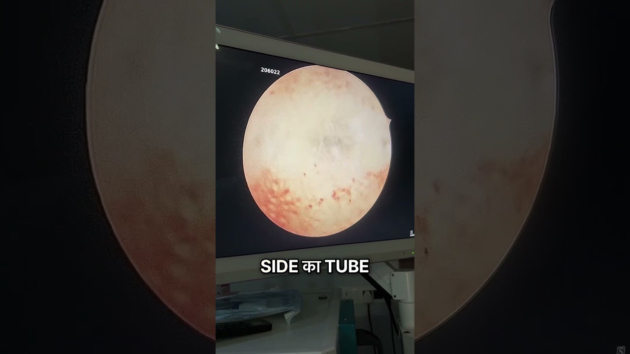 Blocked Tubes Can Make IUI Fail